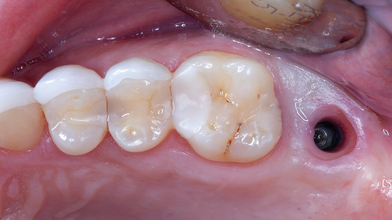 Screw retention was not an ideal choice for this patient due to an unfavorable distribution of sheer forces at the implant site.