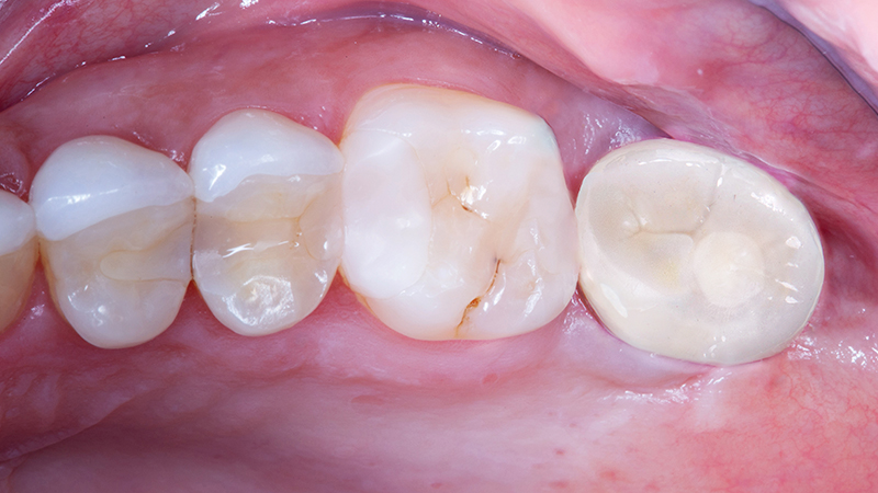 The final restoration was seated  and provided by the custom abutment for better long-term health.