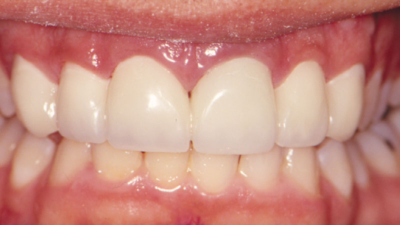 Patient after receiving Transition Crowns & Bridges