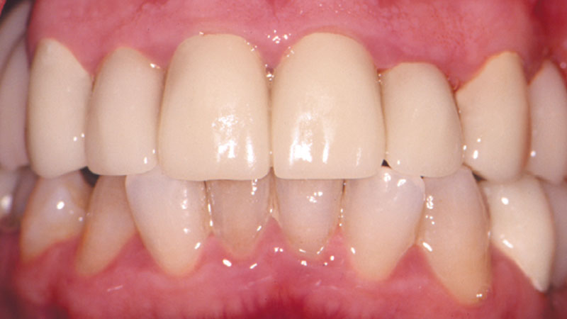 Transition Crowns & Bridges were temporarily added