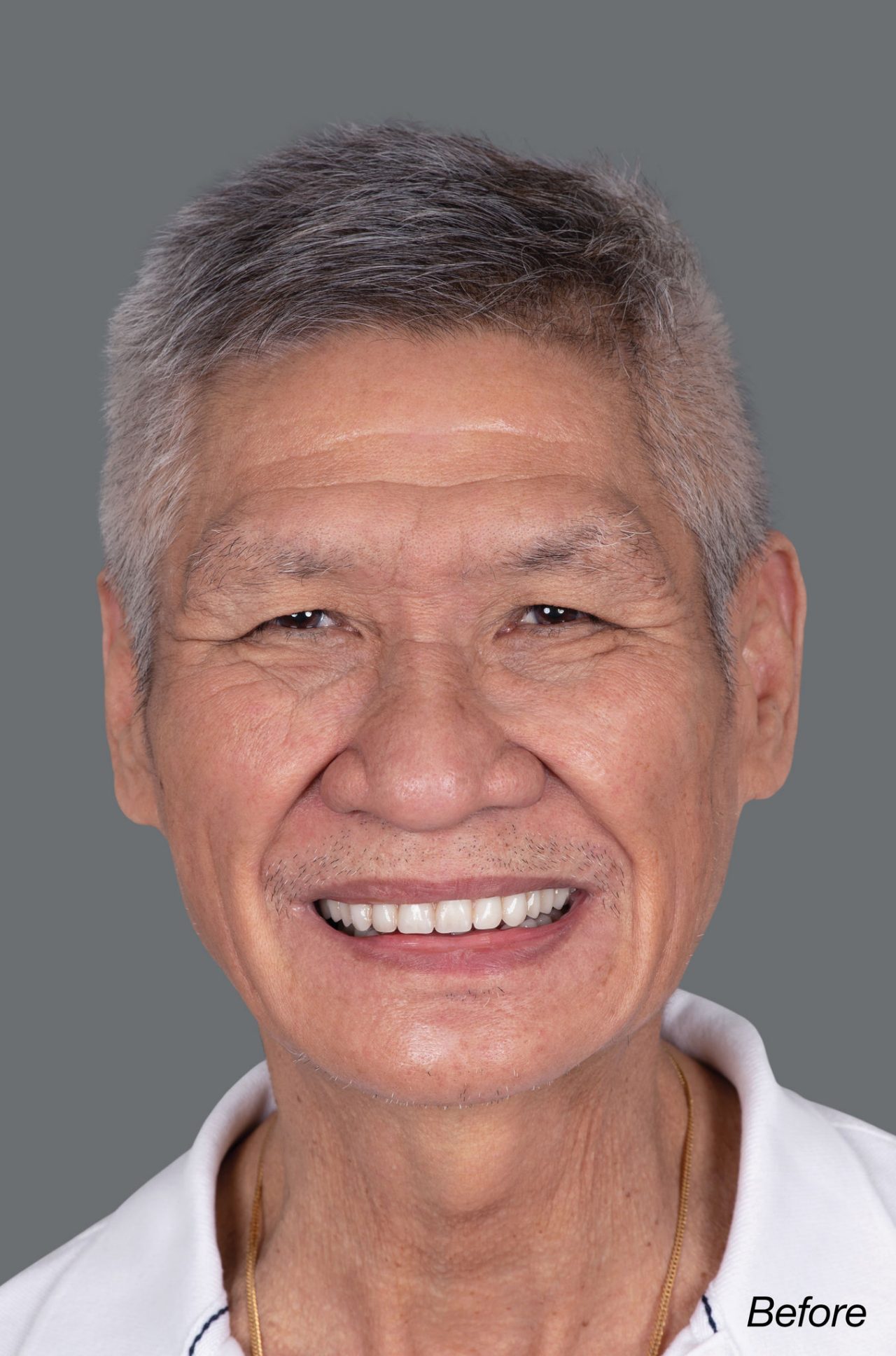 Before Simply Natural™ Copy Dentures