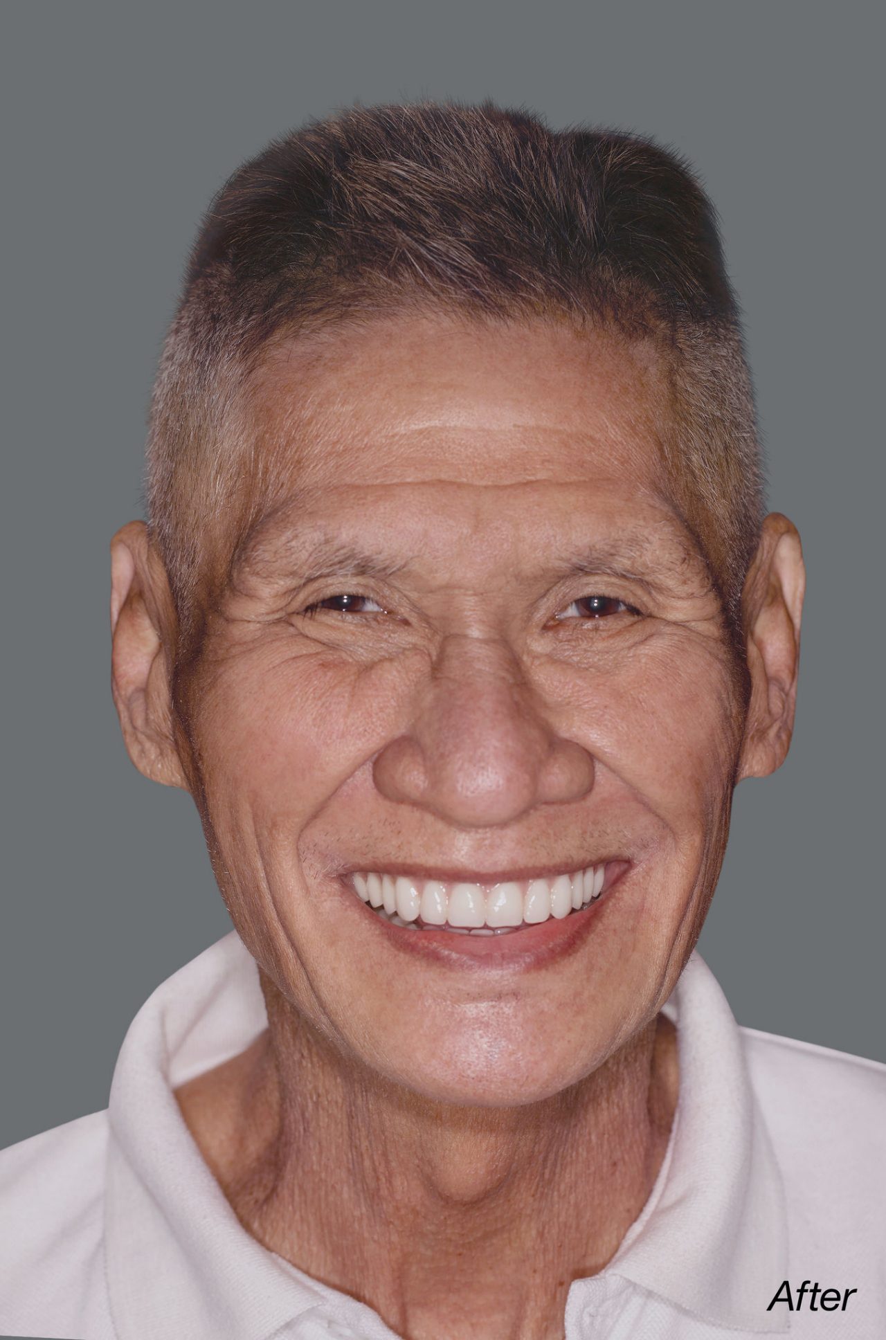 After Simply Natural™ Copy Dentures