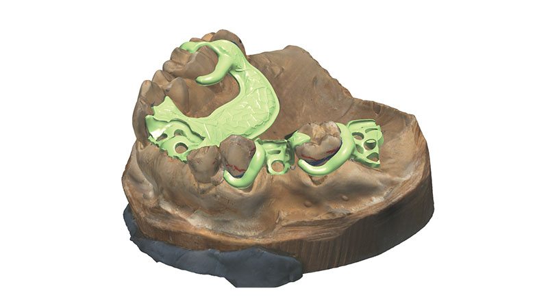 A Digital Rendering of a CAD/CAM-Milled Acetal Partial