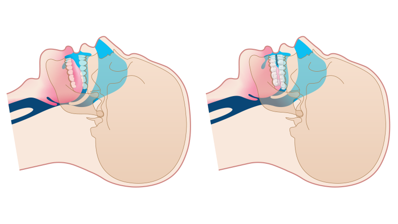 dreamTAP diagram keeping the airway open