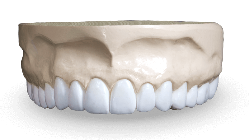 Diagnostic Wax-Ups Product